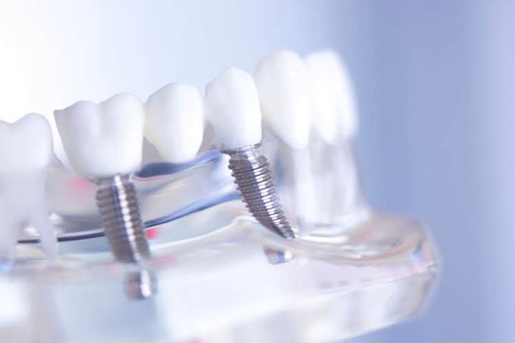 Dental model displaying a titanium implant screw supporting a porcelain crown among natural teeth.