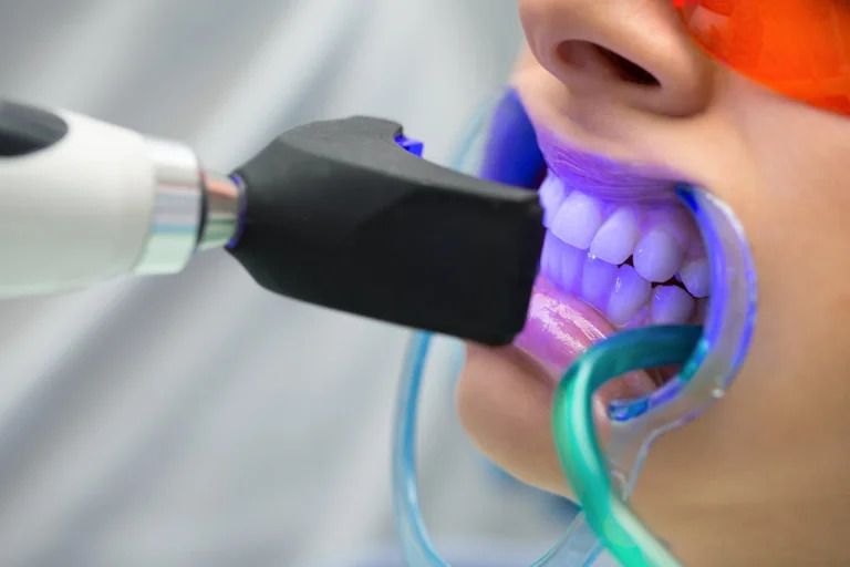teeth-whitening-service