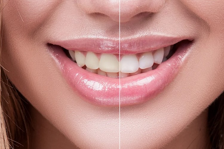 Split-view smile: left side yellowed teeth, right side bright white after porcelain veneers.