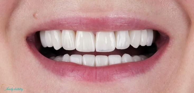 after porcelain veneers at Walk In Family Dentistry