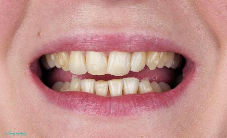 before porcelain veneers at Walk In Family Dentistry