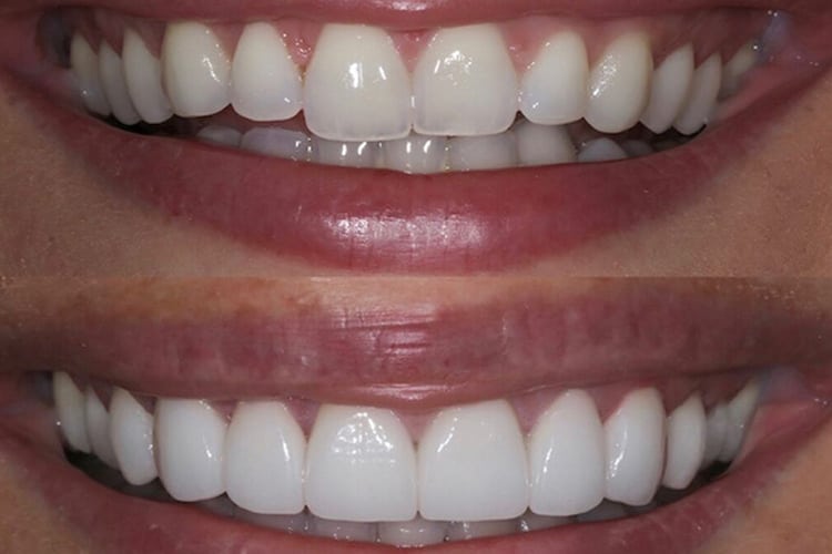 Before-and-after: top natural uneven teeth, bottom straight bright white porcelain veneers.