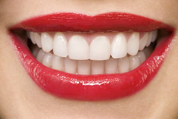 Close-up of bright white porcelain veneers with bold red lipstick.