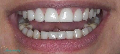 after porcelain veneers at Walk In Family Dentistry