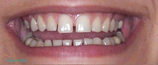 before porcelain veneers at Walk In Family Dentistry