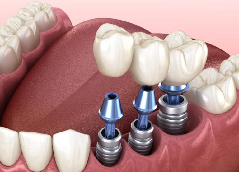 dental implants North York Toronto