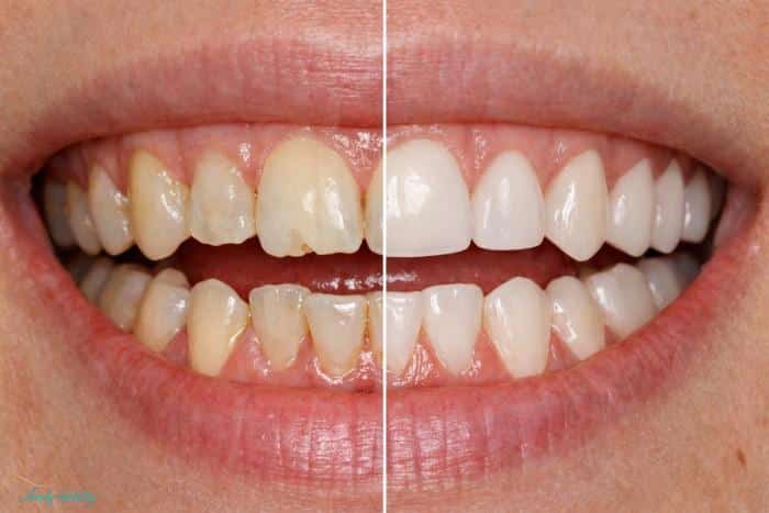 Close-up of teeth with a vertical line in the center, showing before porcelain veneers on the left and after porcelain veneers on the right.
