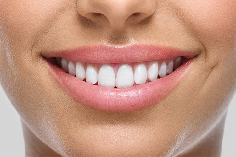 Close-up of flawless, bright white porcelain veneered smile.
