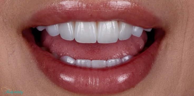 After composite veneers at Walk In Family Dentistry