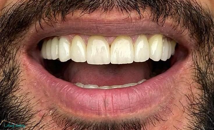 After composite veneers at Walk In Family Dentistry