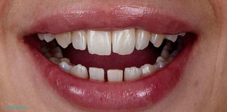 Before composite veneers at Walk In Family Dentistry