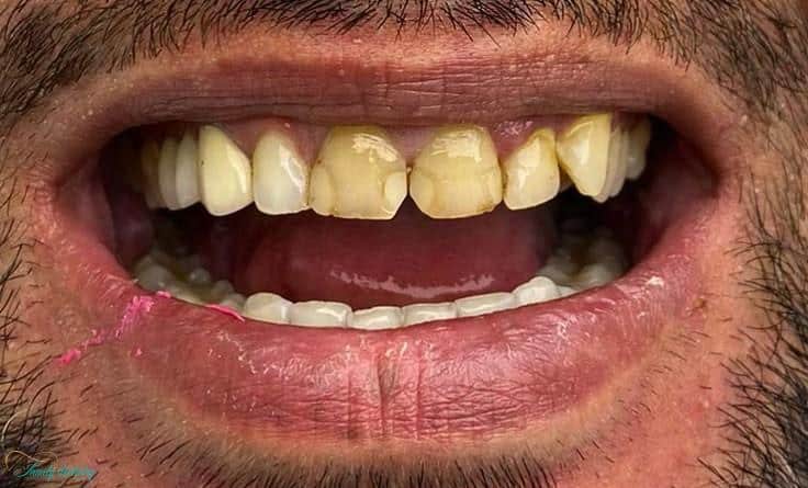 Before composite veneers at Walk In Family Dentistry