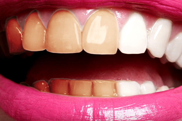 Common causes of tooth discoloration 