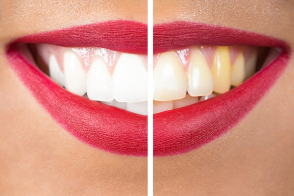 Different colored teeth
