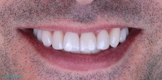 after composite veneers at Walk In Family Dentistry