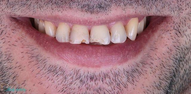before composite veneers at Walk In Family Dentistry