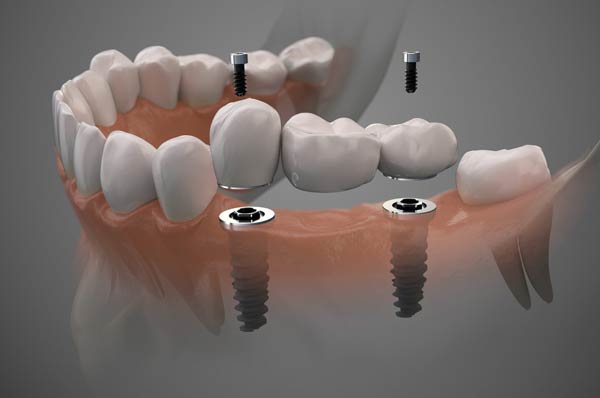 Toronto dental Implants