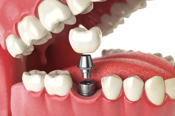 Toronto dental Implants