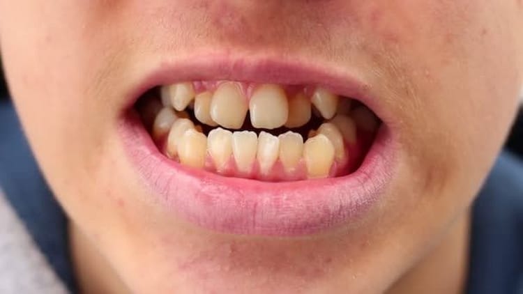 Types of Crooked Teeth