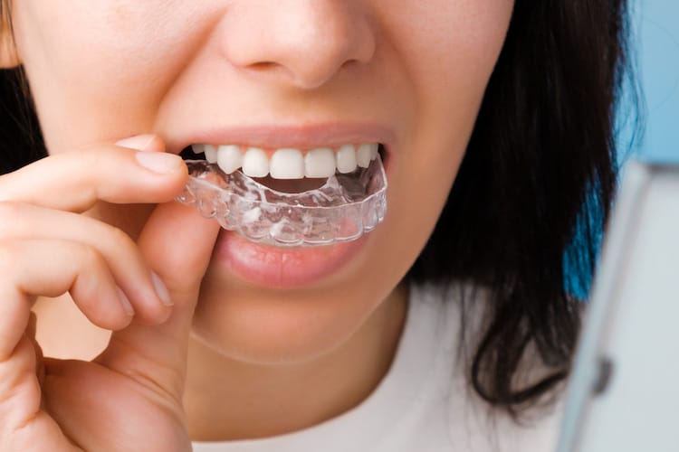 Clear Aligners