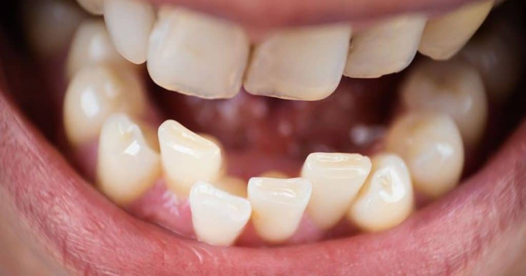 Crooked Teeth? Here’s What You Can Do About It
