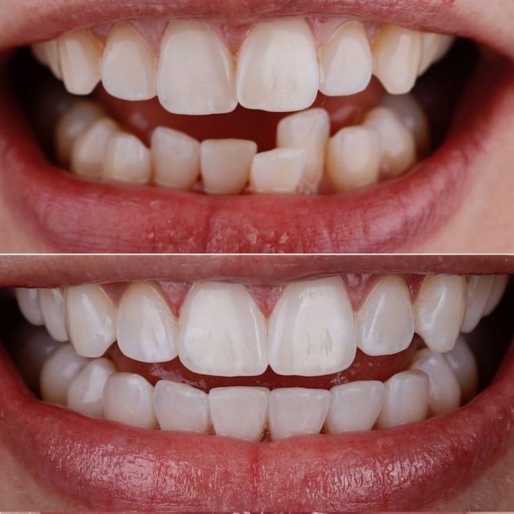 before and after of crooked teeth