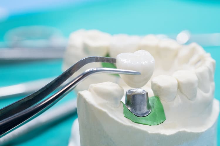 a dental crown in held near a dental implant model.