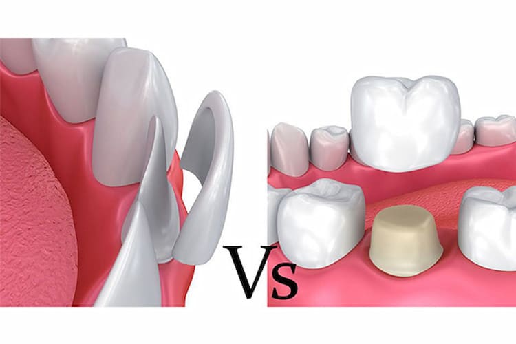 Side-by-side illustration: thin porcelain veneer vs traditional thick dental crown.