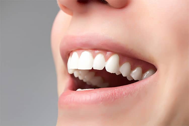 Close-up of flawless, bright white veneered teeth in natural smile.