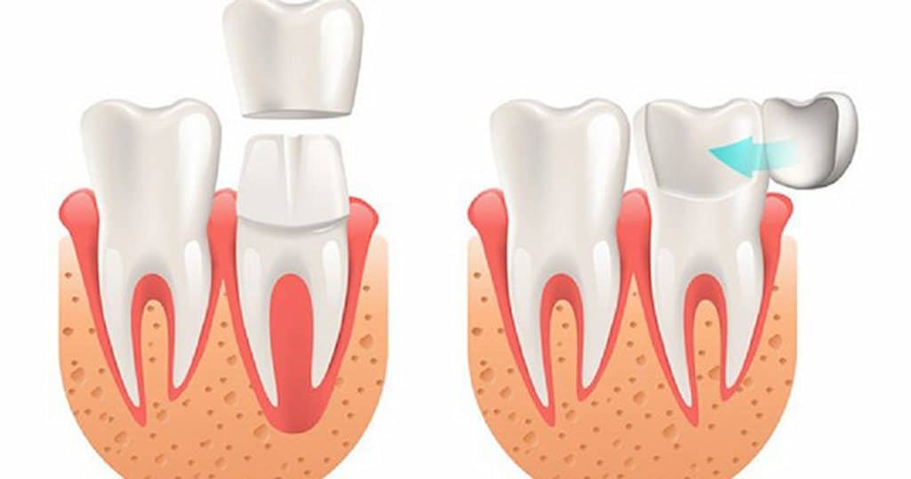 Diagram of veneers and crowns showing minimal-prep veneer placement (left) vs full crown placement (right) on tooth.