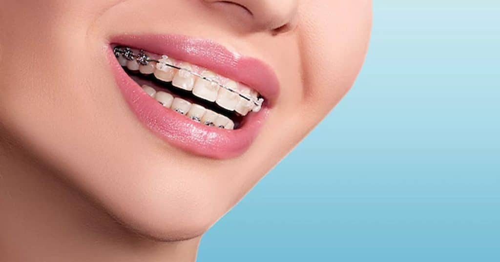 8 Things You Should Consider Before Getting Braces