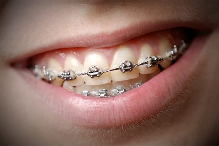 A person who has orthodontic teeth 