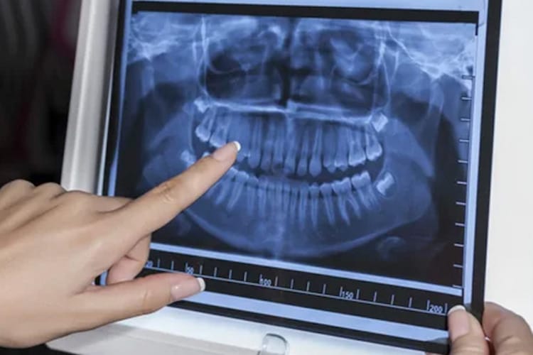 Hand pointing to dental panoramic X-ray on screen.