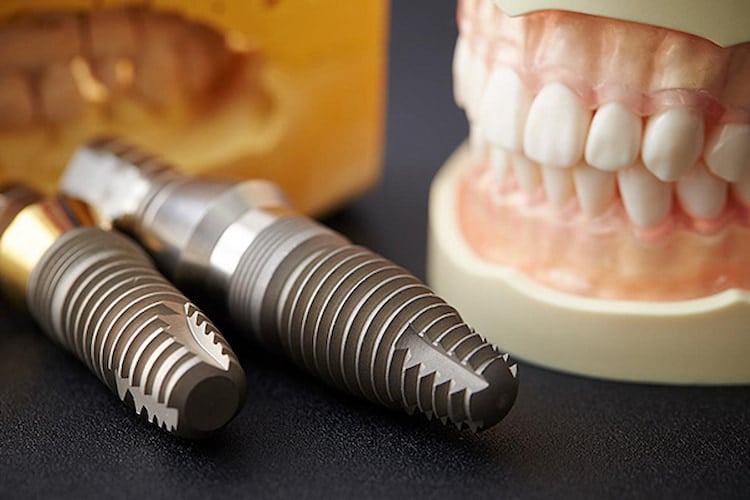 A view of dental prosthesis and implant 