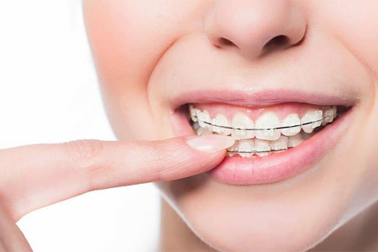 a woman smiling and pointing to her Dental orthodontics.