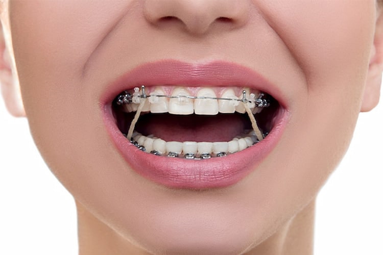 a person with an open mouth and orthodontic appliances. 