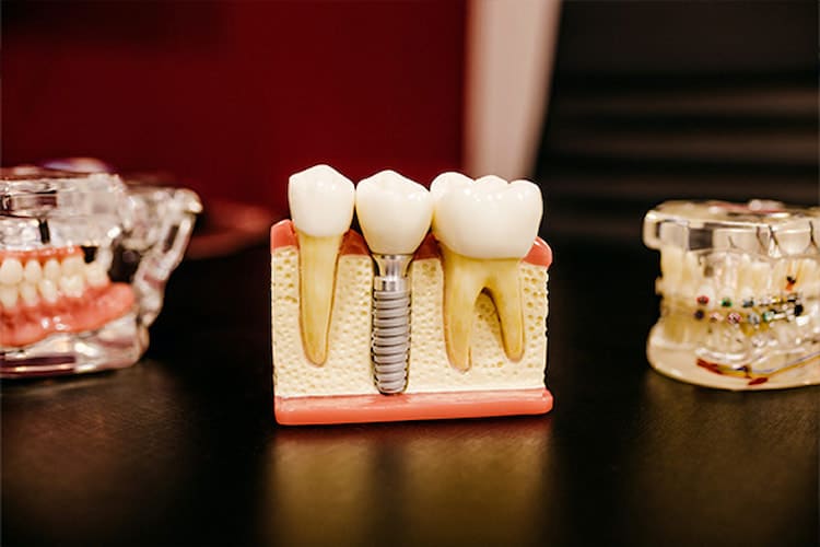 dental implant model next to models of braces and teeth.