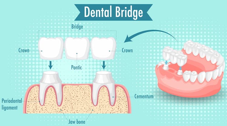 an illustration showing different parts of a dental bridge.
