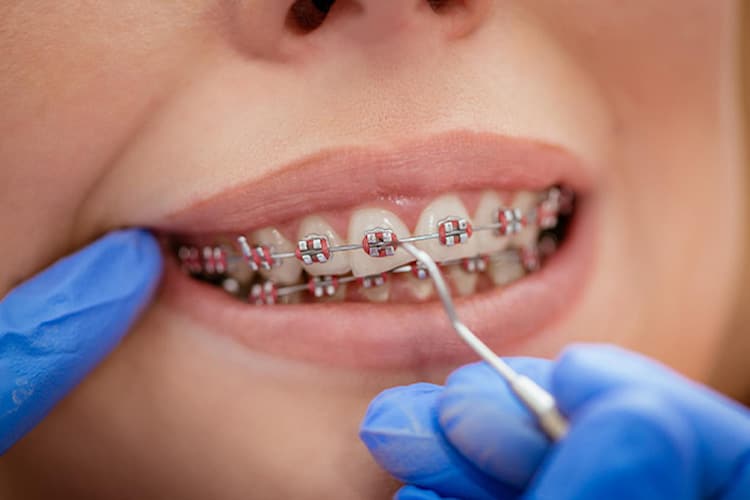 close-up of a woman wearing dental braces and a dentist is fixing them on her teeth. 