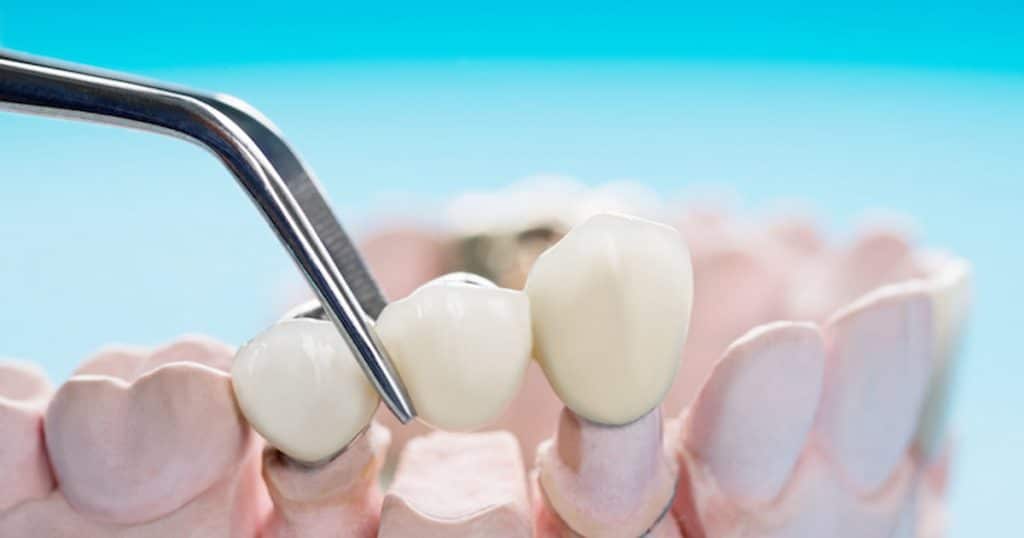 Types of Dental Bridges: a model of dental bridge.