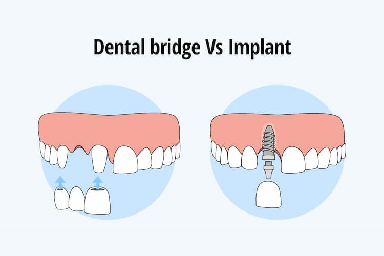 dental bridge vs implants, showing how each option works.