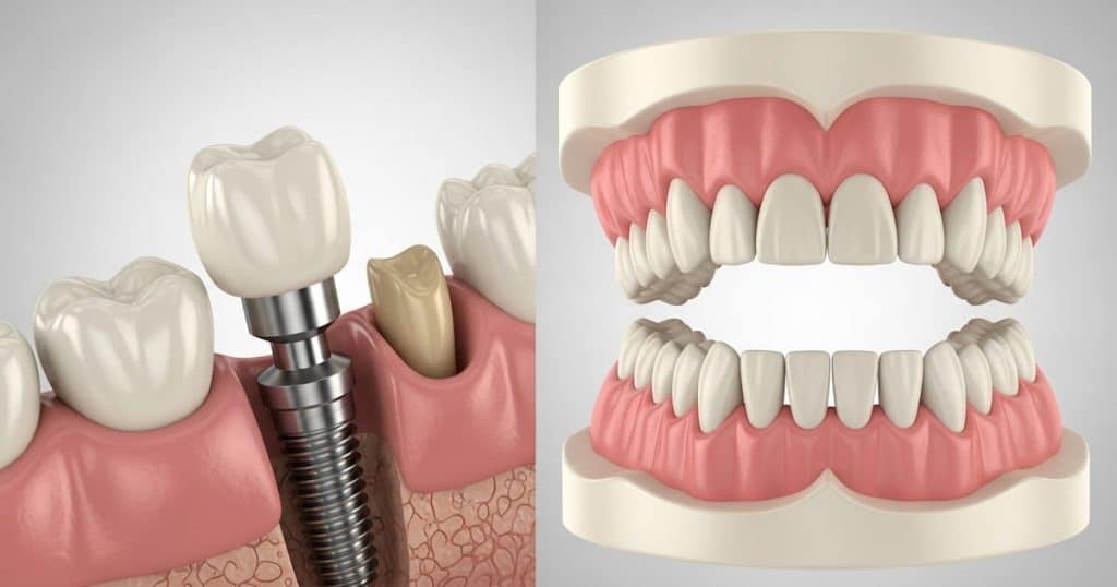 Dentures vs. Dental Implants