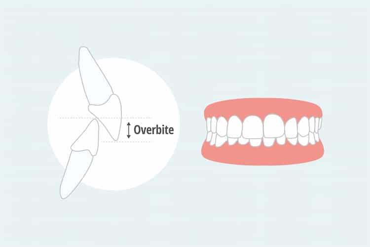 what is an overbite? two teeth which the upper tooth overlaps the lower one.