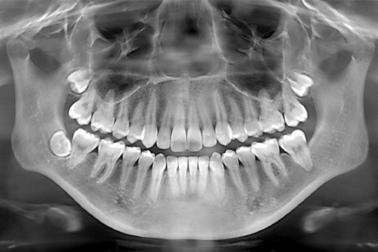 Full panoramic dental X-ray showing teeth and jaw.