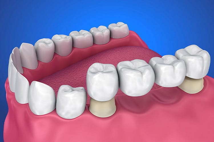 Dental Bridges as the First Dental Implant Alternative