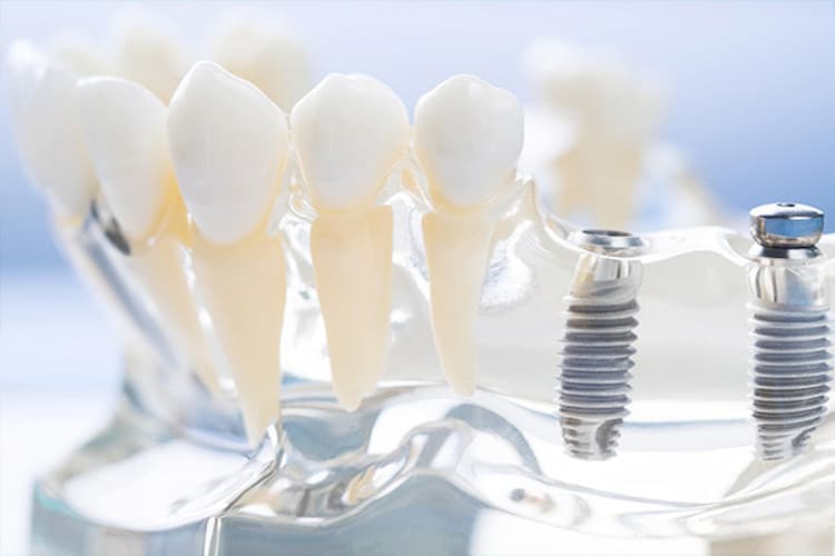 dental implants model