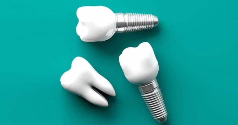 one tooth model and two dental implant models on a surface showing Dental Implants Alternatives