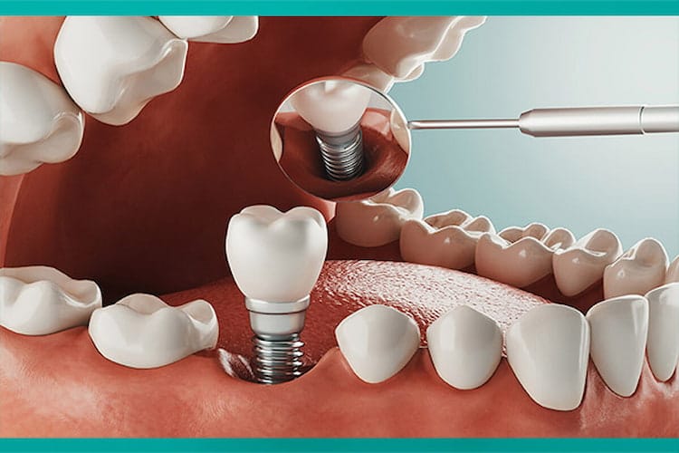 a dental implant is being placed in a tooth hole. 