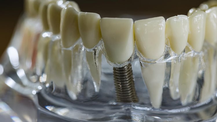 a model of titanium dental implants displaying its biocompatible properties.