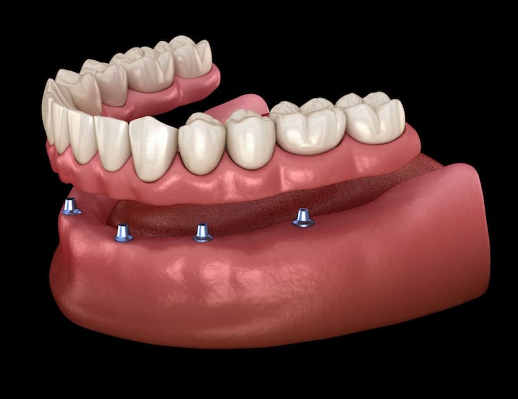 an illustration of implant dentures
